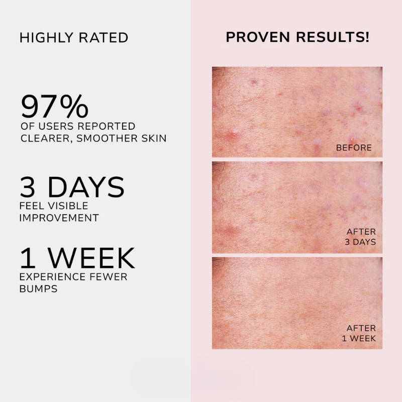 Butt Acne Botanical Cream