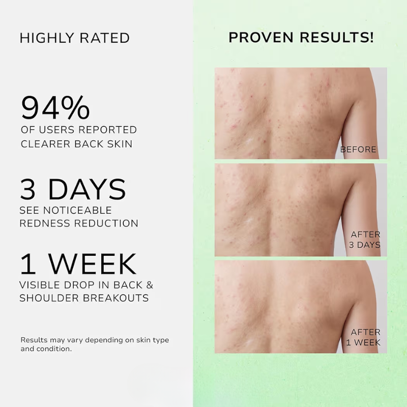 Back Acne Botanical Spray