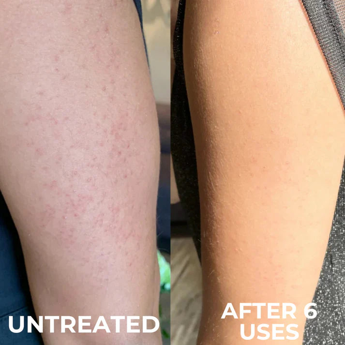 Advanced Triple Acid Complex for Keratosis Pilaris