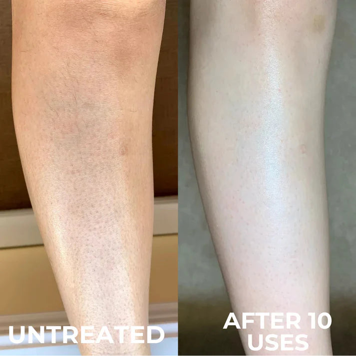 Advanced Triple Acid Complex for Keratosis Pilaris